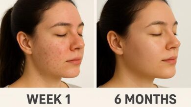 Tretinoin