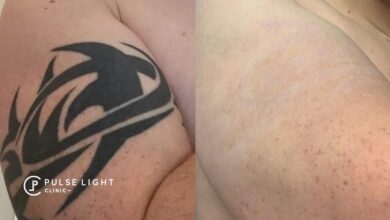 Tattoo Removal in London
